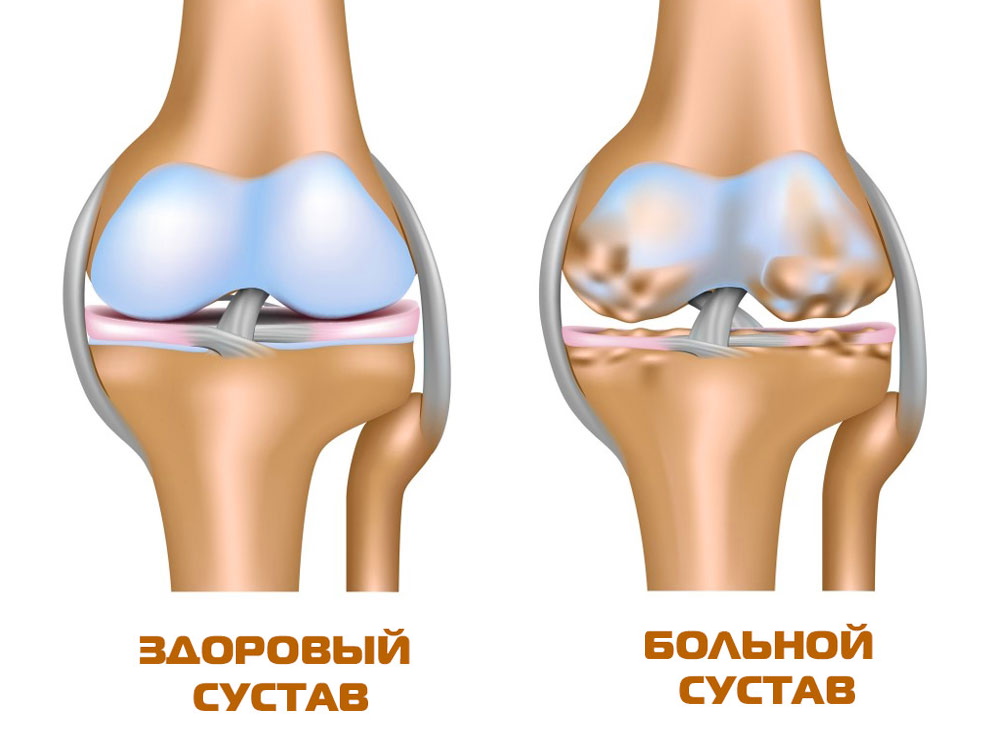 Артроз коленного сустава лечение | Операция на колене | Москва